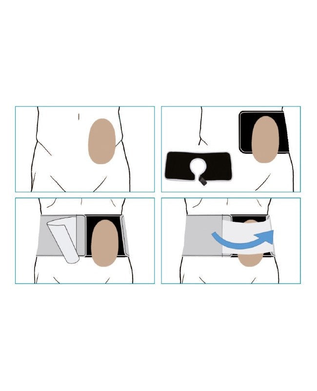 オストミーサポートベルト - Orione 型番3052 - 高さ16cm（6.3インチ）